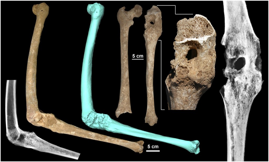 Figura 4 da Bartsiokas et al. 2015, PNAS. Vista laterale della gamba sinistra dell'individuo 1 in flessione mostra la massiccia anchilosi al ginocchio. (Foto: : A. Bartsiokas)