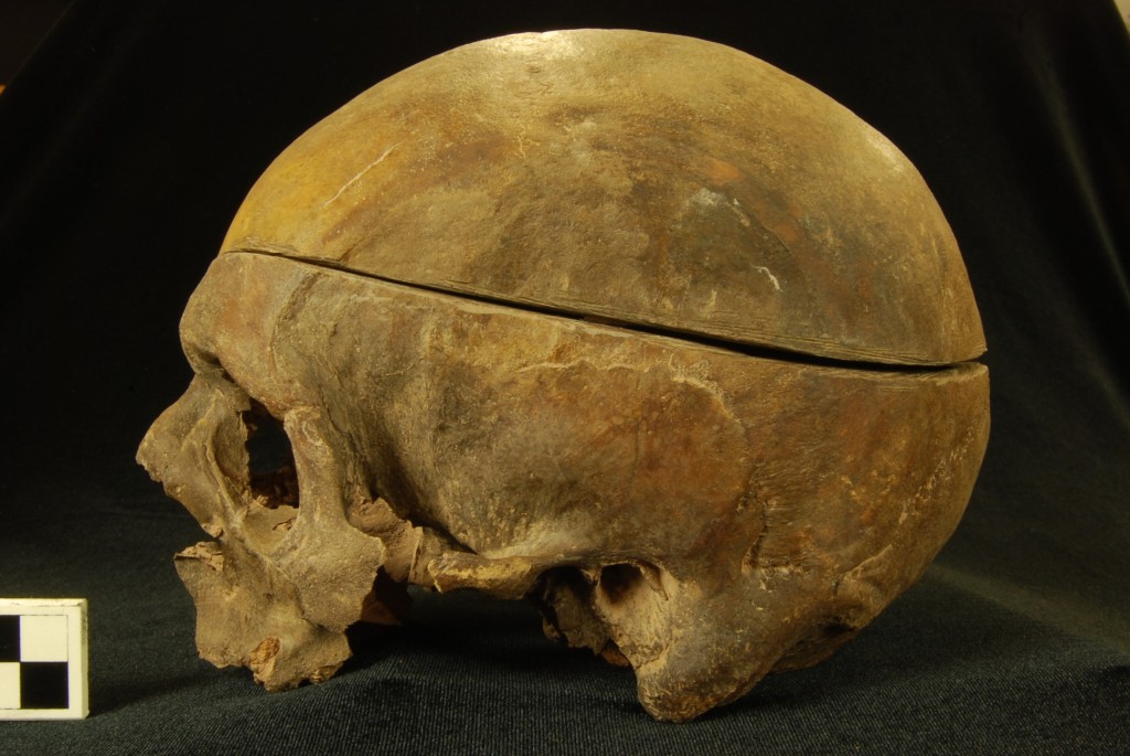Evidenza di craniotomia dal cimitero del XIX secolo della Erie County Poorhouse I poveri e i neri sono stati sottoposti a dissezione in percentuali spropositate nelle scuole di medicina, spesso perché i loro corpi sono stati trafugati dai tombaroli. (Foto: K. Nystrom)
